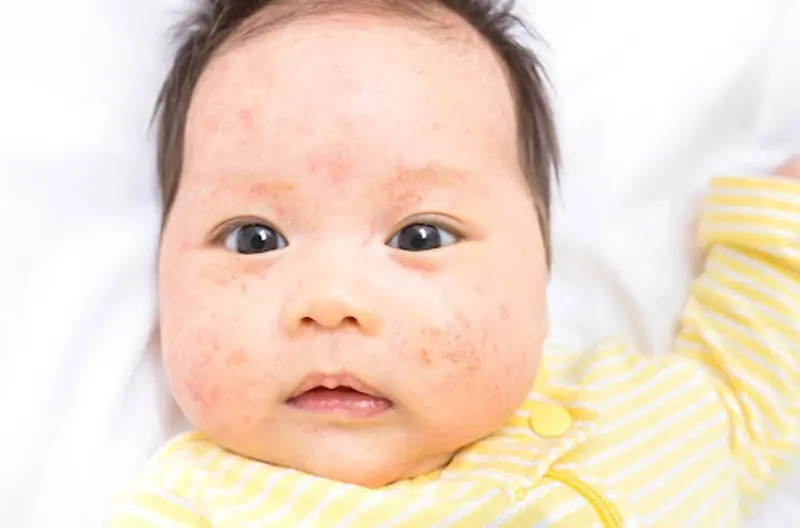 علائم حساسیت نوزاد به تخم مرغ در شیر مادر